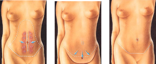 Gaine Post Opératoire Abdominoplastie ou Liposuccion Abdominale