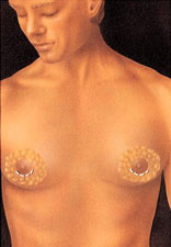 gynecomastie