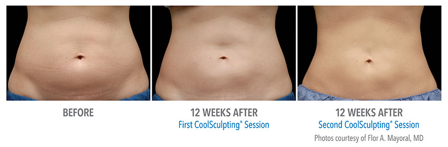 How Effective Is CoolSculpting?: Chrysolite Aesthetics : Aesthetic Medical  Spa