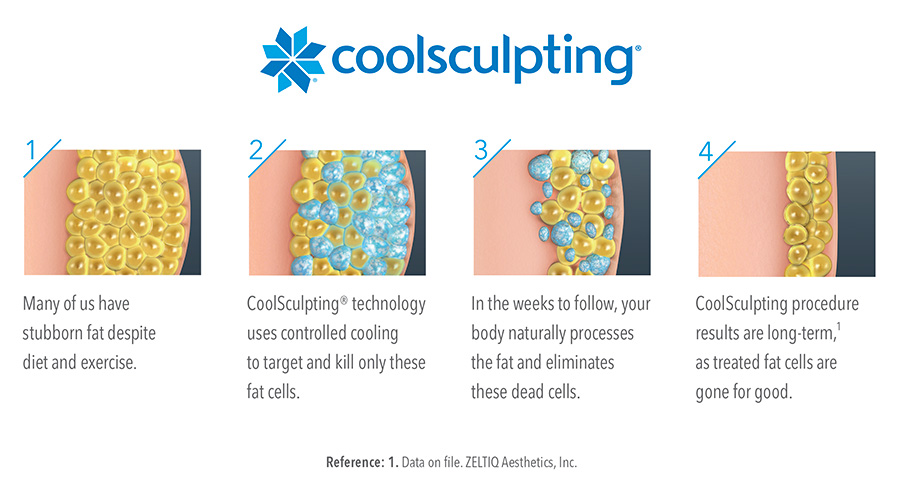 Coolsculpting - Incognito MediSpa